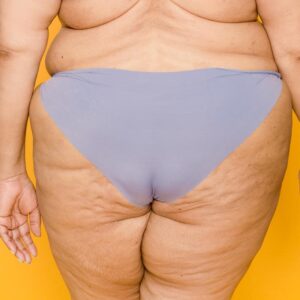 aumento de glúteos sin cirugía, aumento de gluteos sin cirugia, ácido hialurónico aumento, seguridad, efectos, modelado, cuidado precio, viales, retoque, número, gluteos, diagnóstico, madrid, músculo, inyecciones, nalgas, ocasiones, cuidados, hinchazón, boca, figura, liposucción, indicaciones, efectos, duda, hospitalización, profesionales, invasivo, áreas, acido, rostro, exceso, cuidado, sitio web, experiencia, clinica, barcelona, resultados