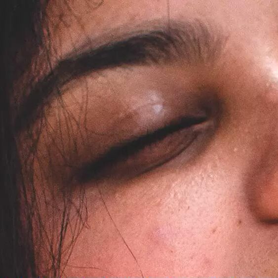 Carboxiterapia ojeras Barcelona Carboxiterapia ojeras Barcelona