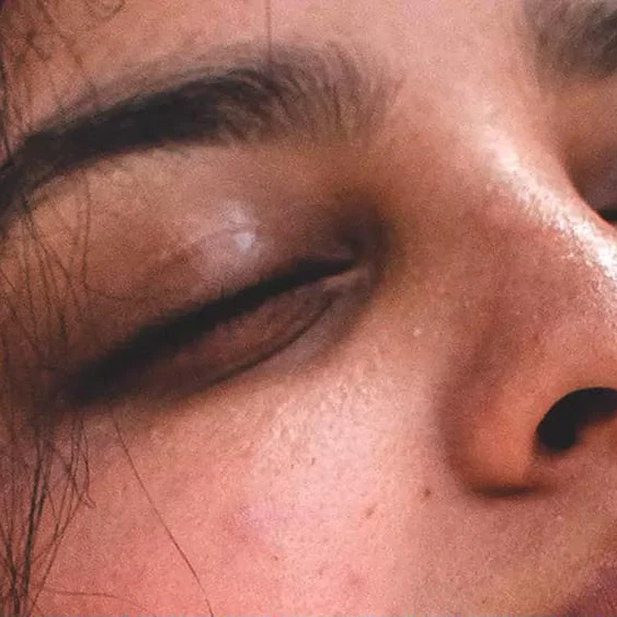 relleno-ojeras-dra-blanco-barcelona-03 Relleno de ojeras con ácido hialurónico : el tratamiento estrella para una mirada rejuvenecida.