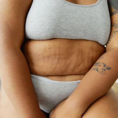 Doctora-Blanco-Medicina-Estetica-Barcelona-Mesoterapia-Estrias-3