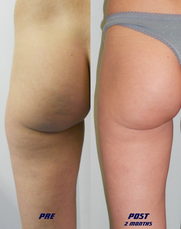 Antes y después en gluteolofit 