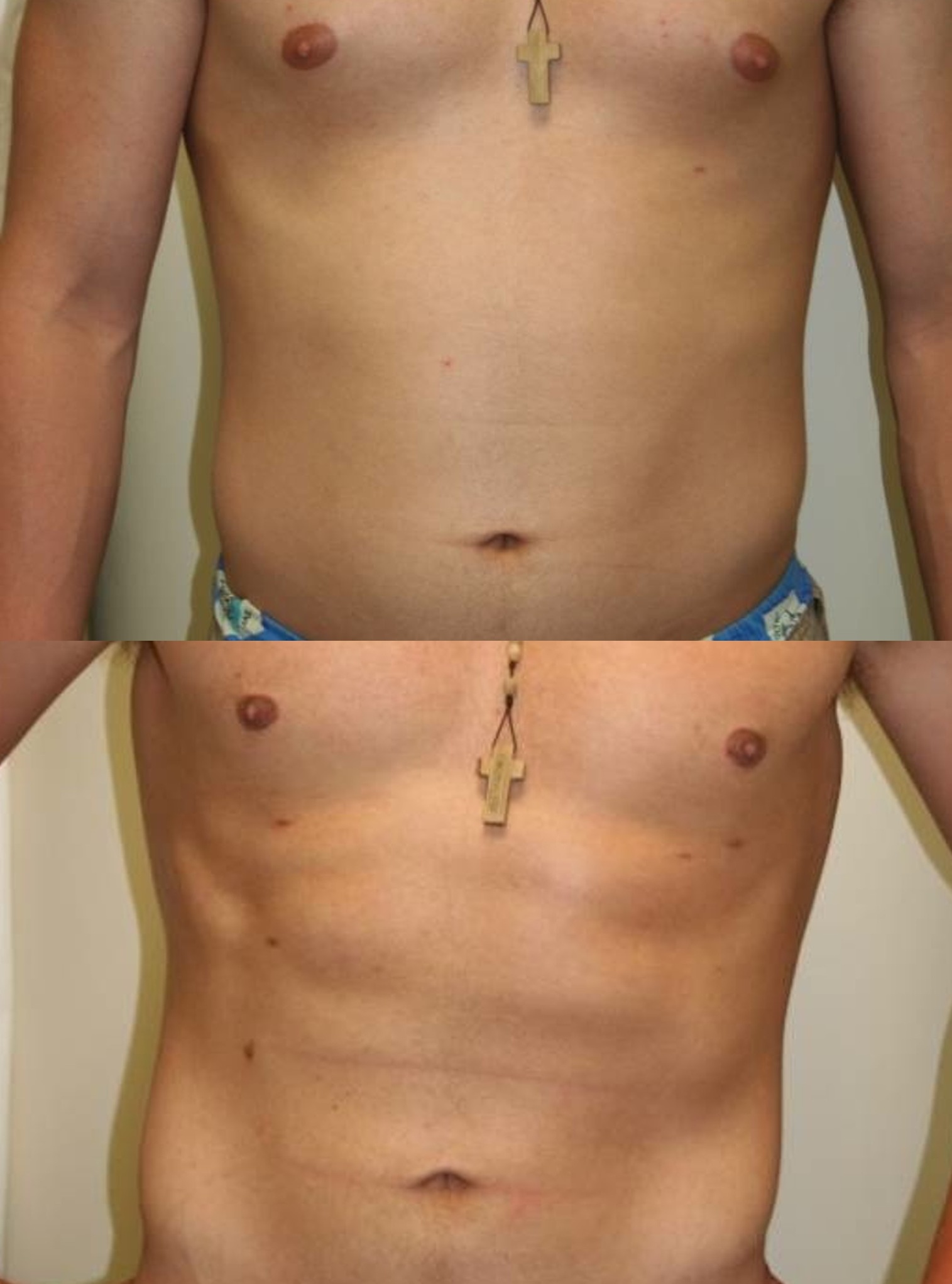 Comparación de abdomen de paciente masculino antes y después de un procedimiento estético, mostrando reducción de grasa abdominal y mejor definición muscular.