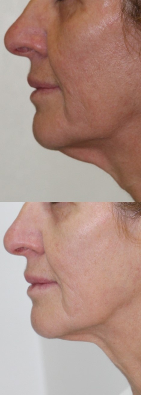 Vista de perfil de cuello y mentón de paciente antes y después de un procedimiento de tensado de cuello, mostrando mejor definición del ángulo cervicomentoniano.