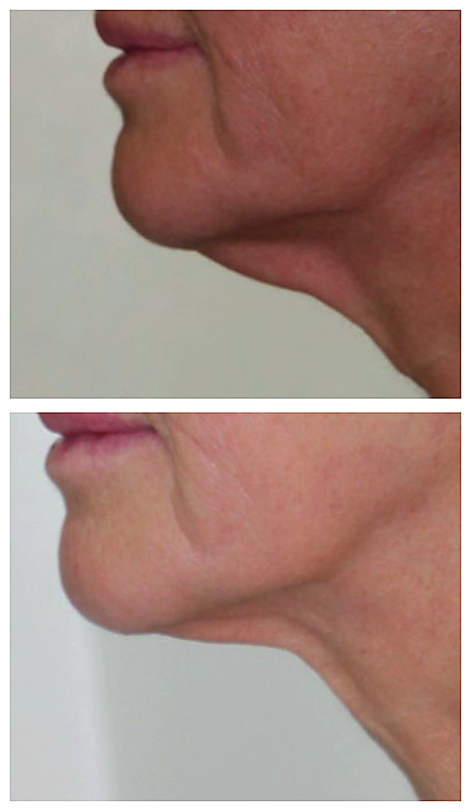 Antes y después reducción de papada con tratamiento Endolift facial Barcelona