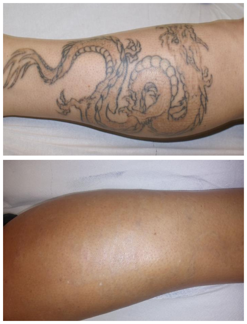Eliminación de tatuaje grande con láser Discovery Pico tras varias sesiones