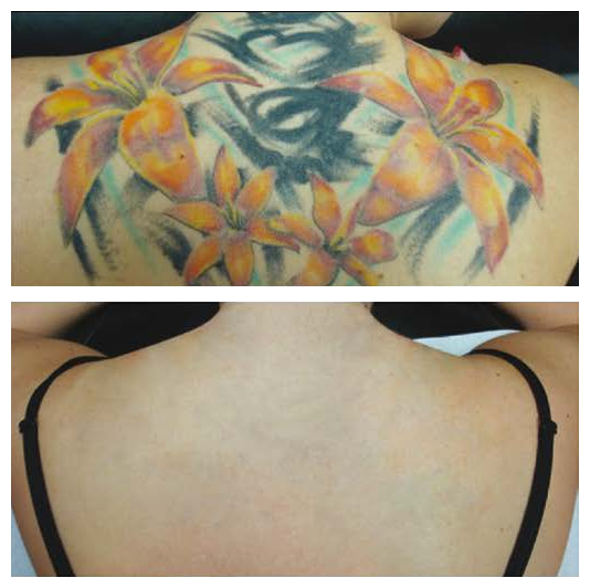 Antes y después eliminación de tatuaje a color con láser picosegundo Barcelona