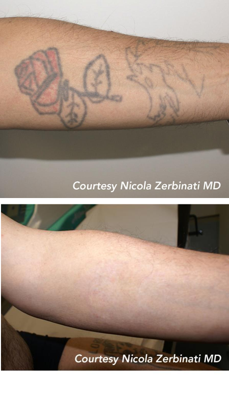 Resultado tratamiento láser picosegundo Barcelona en tatuaje de brazo