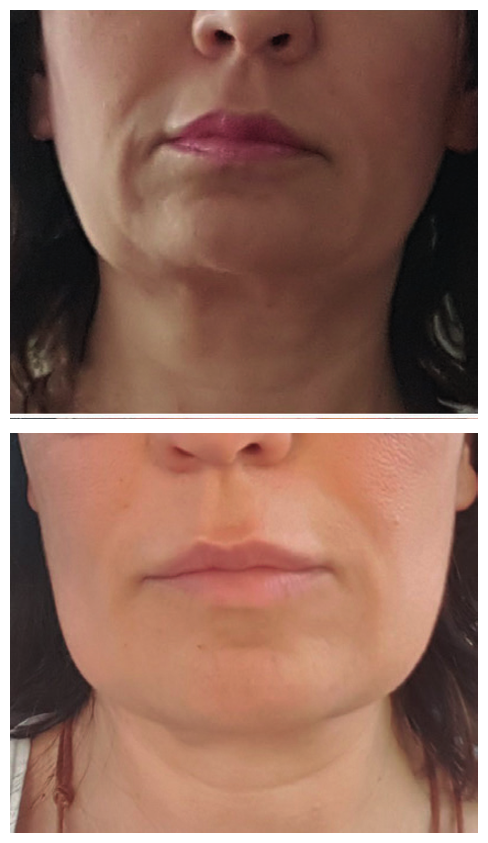 Antes y después tensado de piel y reducción de arrugas con Endolift facial