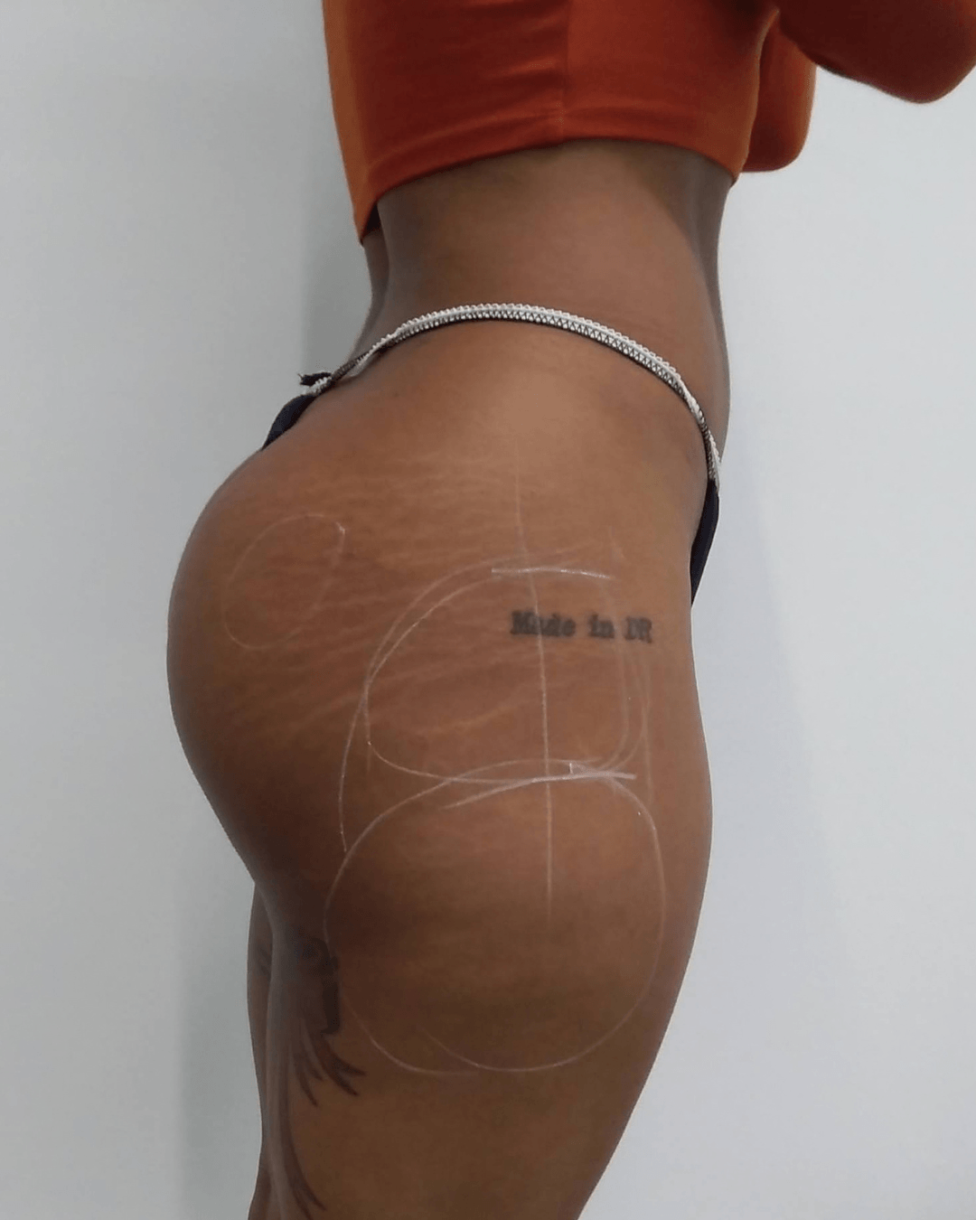 Glúteos después del tratamiento con ácido hialurónico - Clínica Doctora Blanco Barcelona