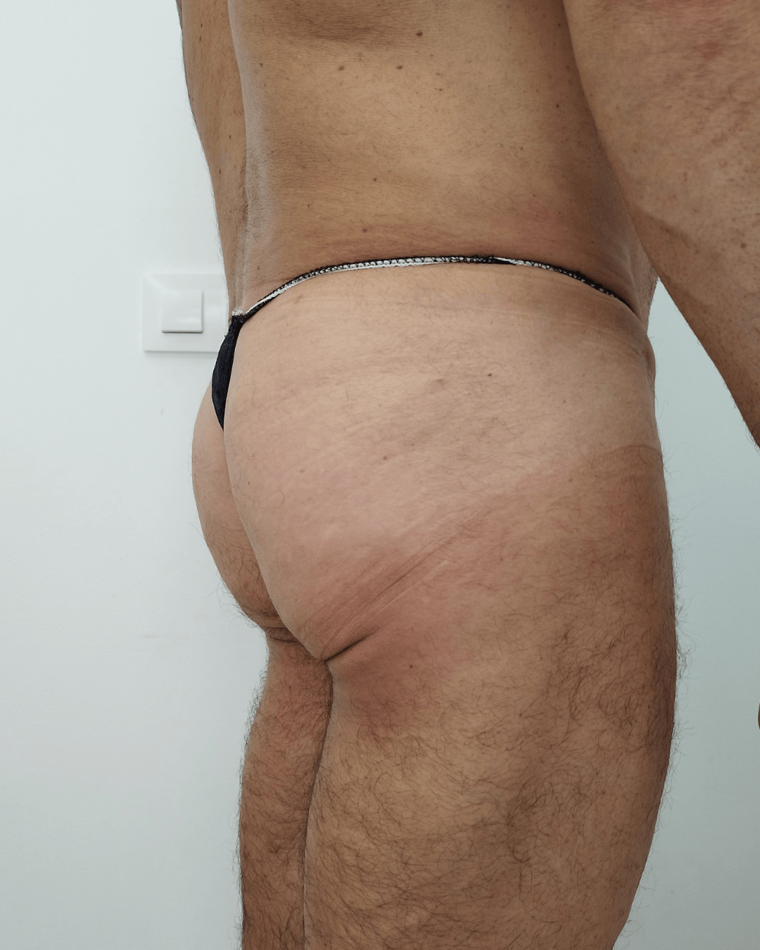 Glúteos después del tratamiento con ácido hialurónico - Clínica Doctora Blanco Barcelona