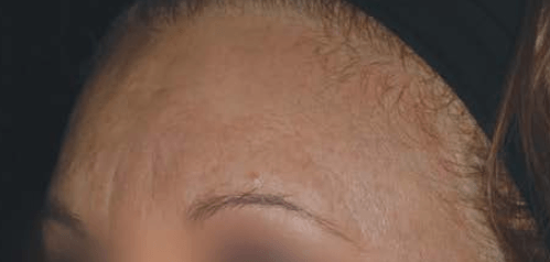 Después: mejora de textura y manchas de la piel con láser picosegundo Barcelona