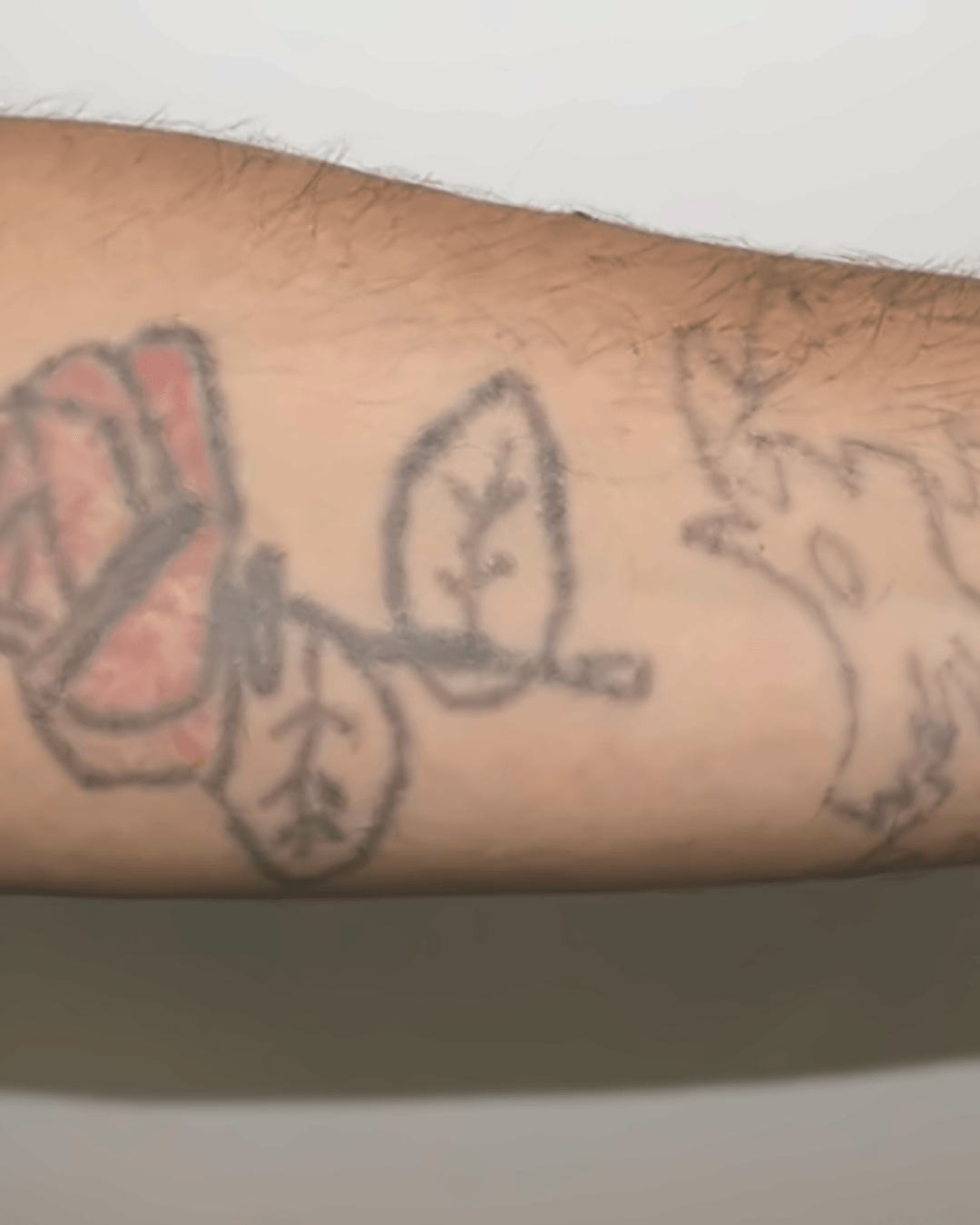 Antes de eliminar tatuaje de brazo con láser picosegundo Barcelona