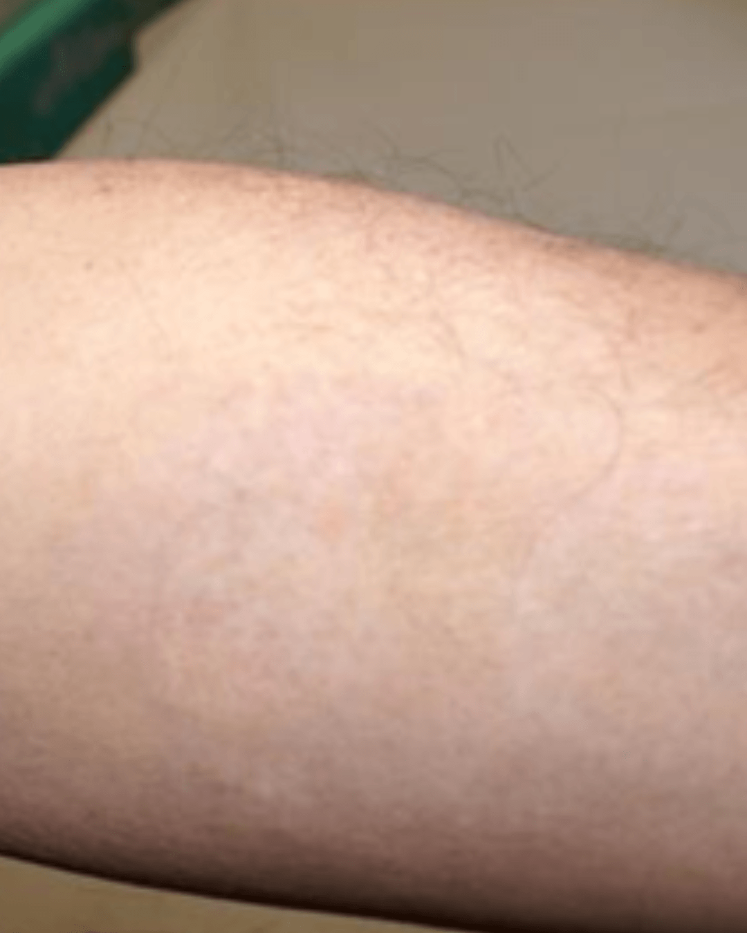 Después de eliminar tatuaje de brazo con láser picosegundo Barcelona